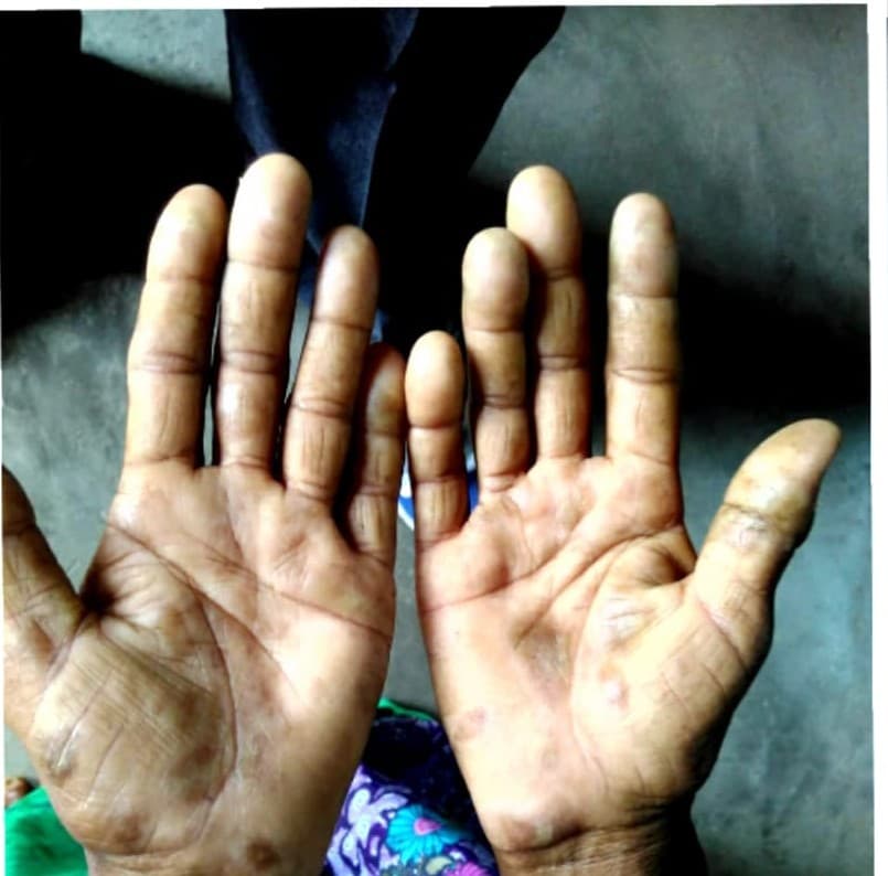 After treatment