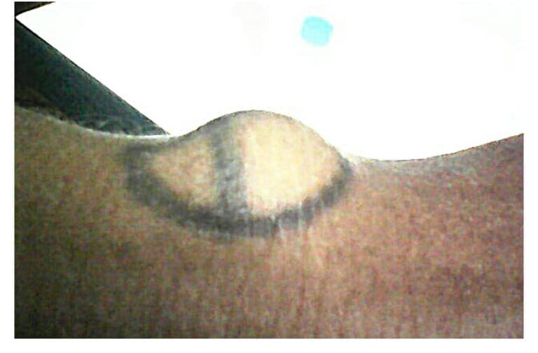 Before treatment