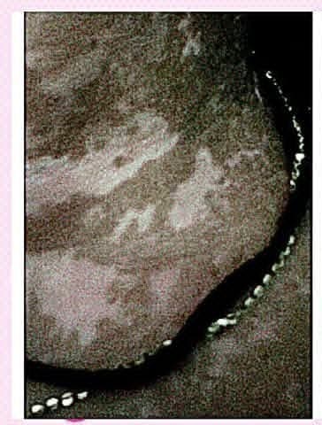 Before treatment