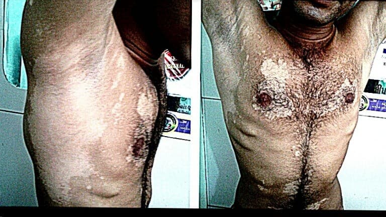 Before treatment