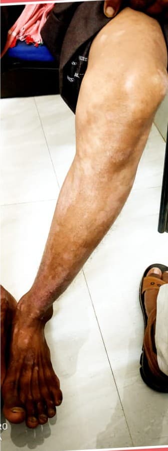After treatment