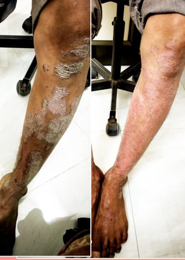 Before treatment