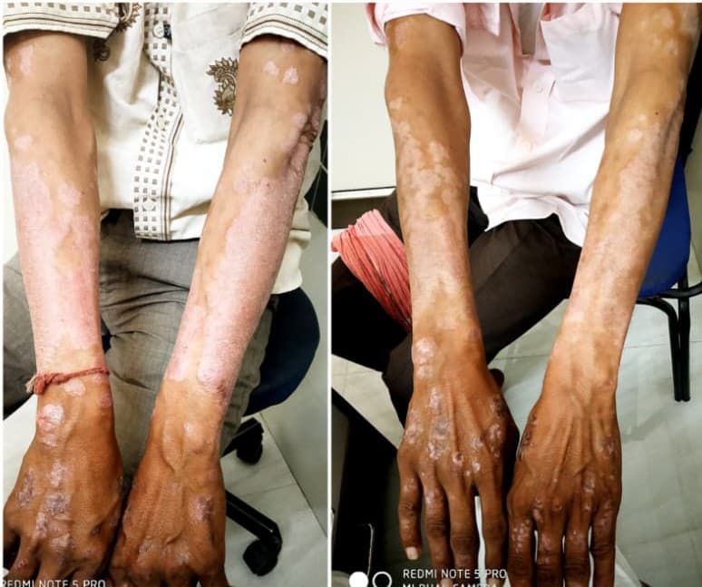 Before treatment