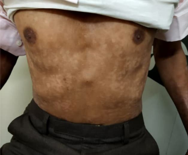 After treatment