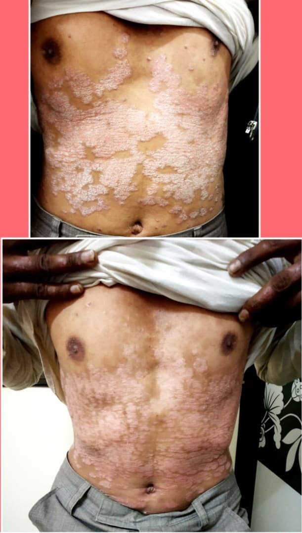 Before treatment