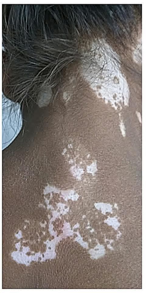 After treatment