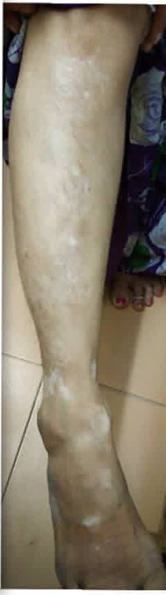 After treatment