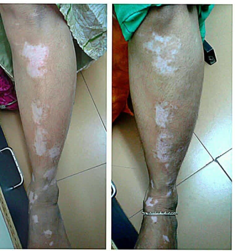 Before treatment