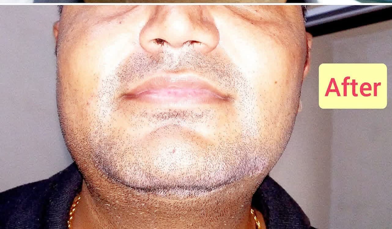 After treatment