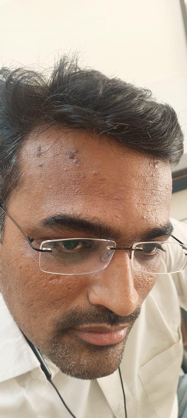 Before treatment