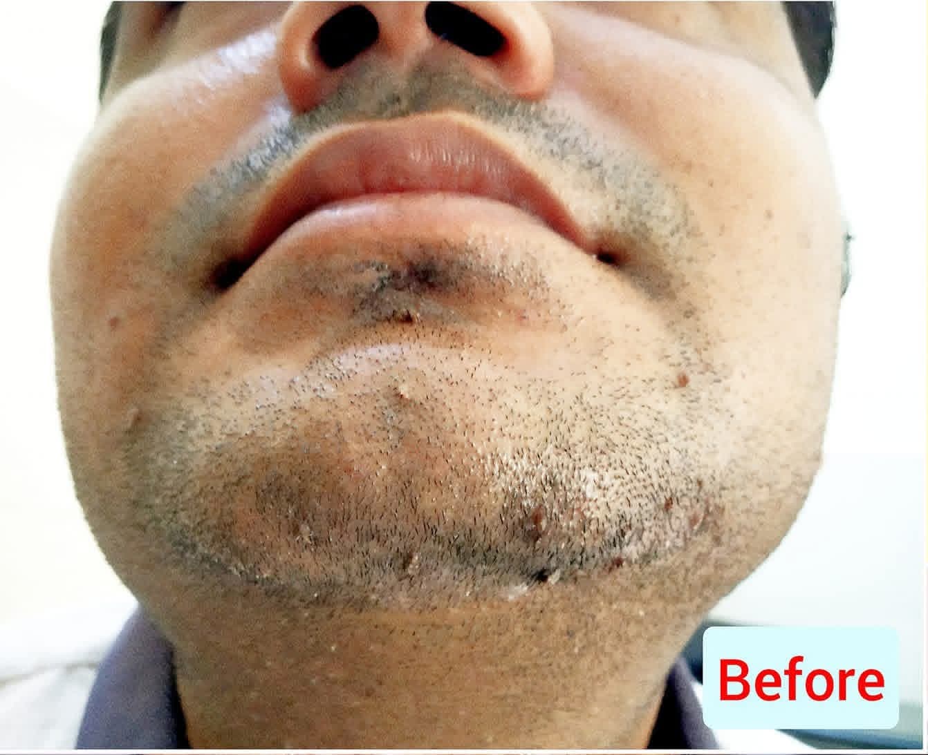 Before treatment